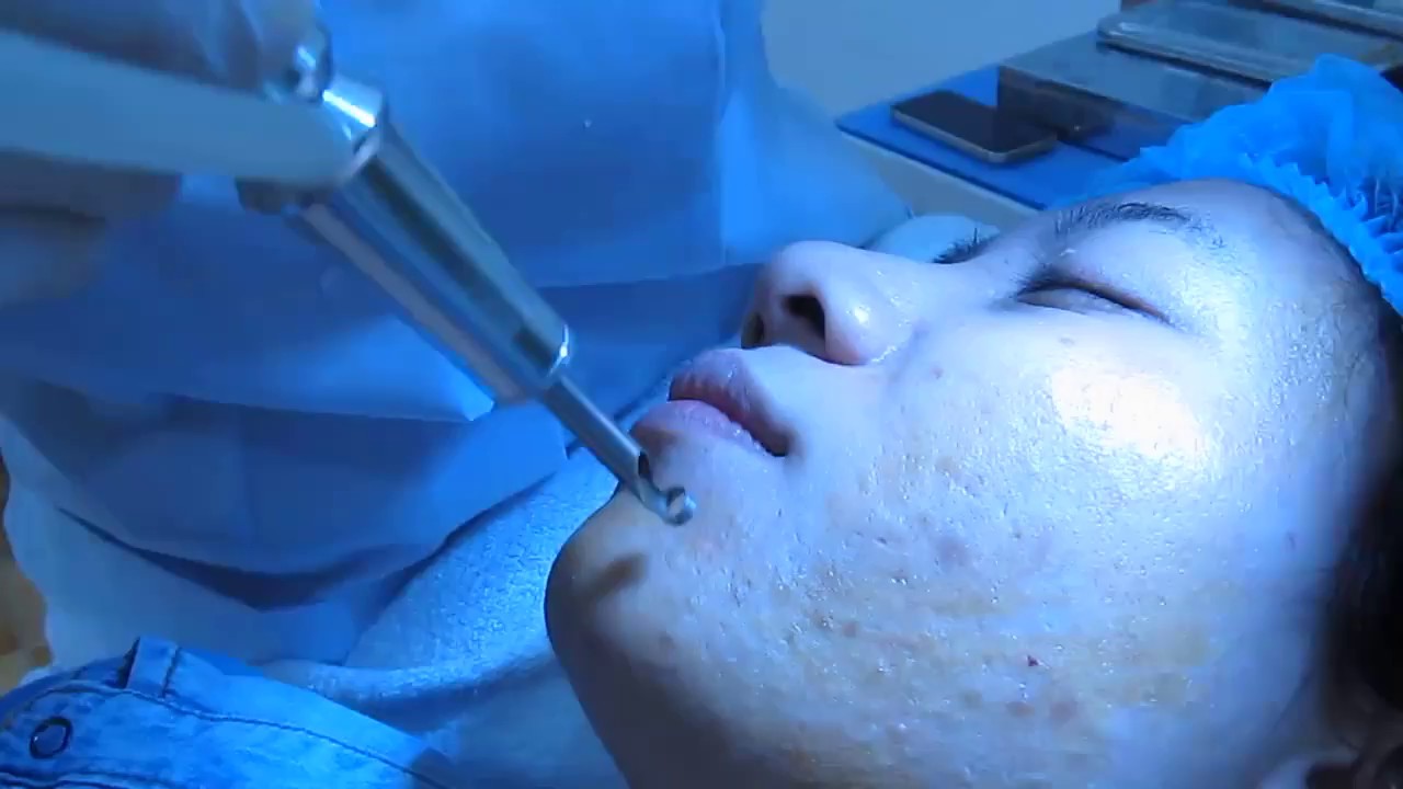 Laser - Ánh Sáng Xanh Trị Mụn Viêm
