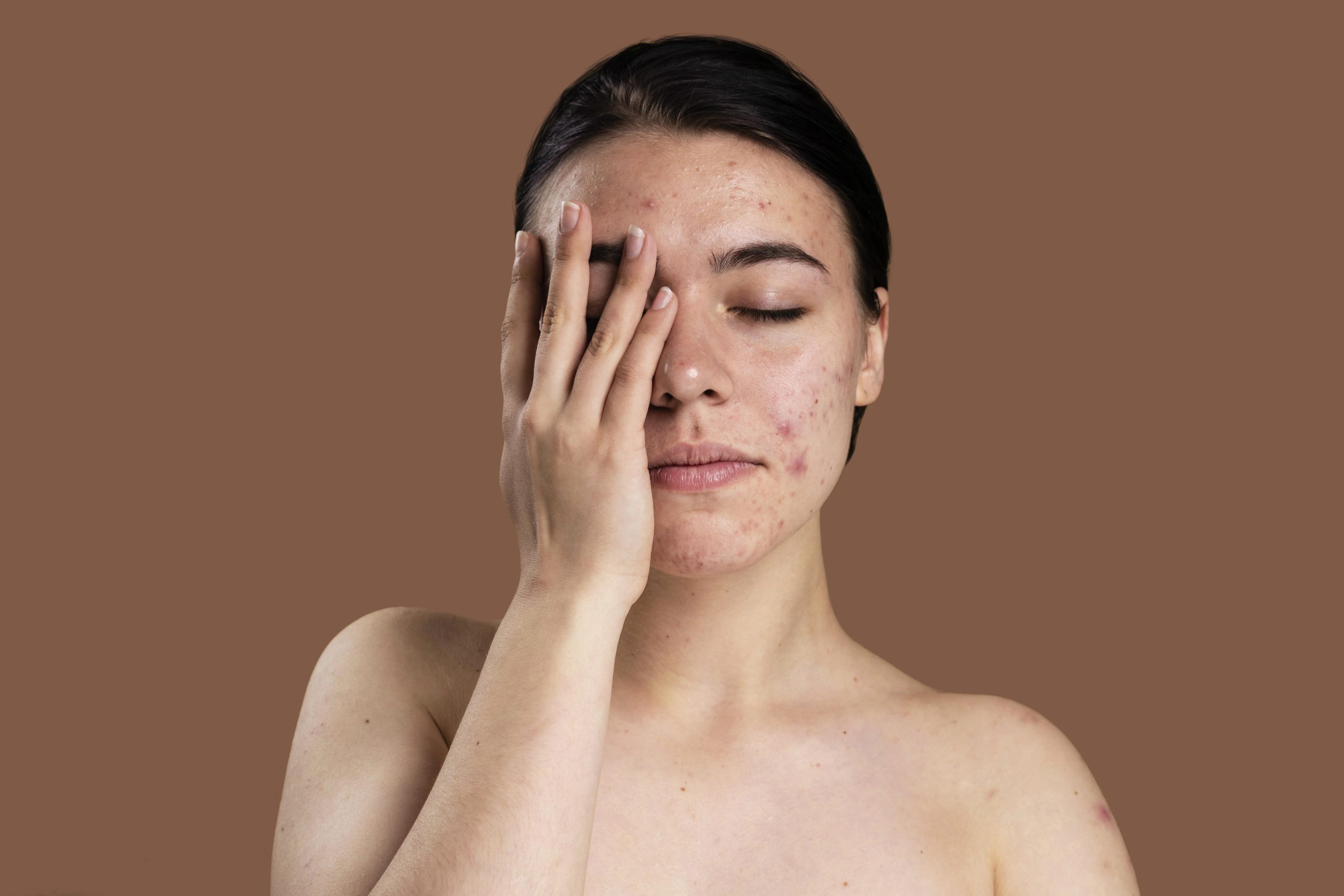 Cách điều trị mụn nhọt