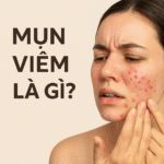 Mụn Viêm Là Gì?